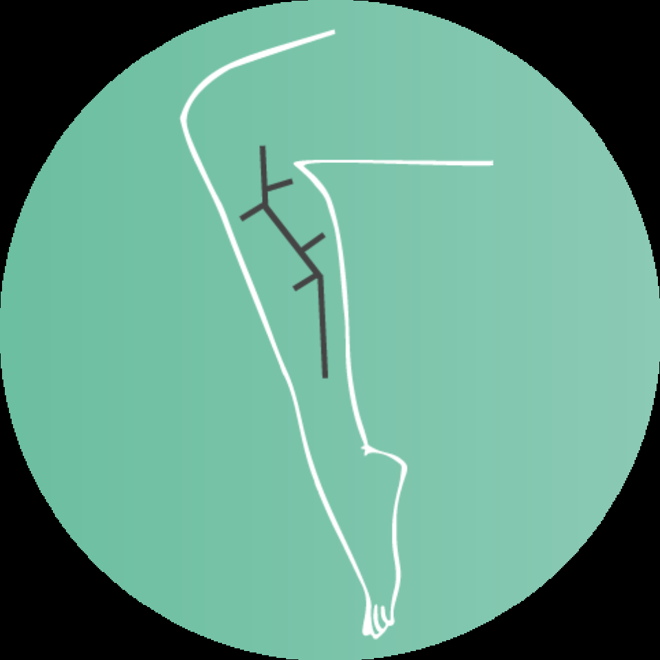 Asset 3krampfadern